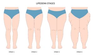 i diversi stadi del lipedema